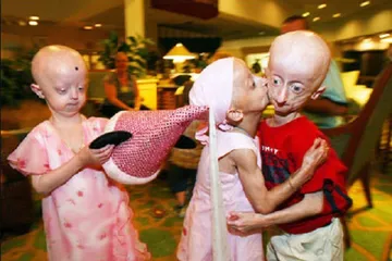 Check out 8 strange diseases1